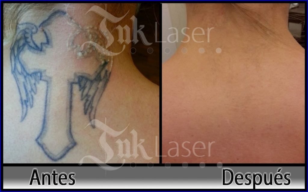 mejor laser para borrar tatuajes