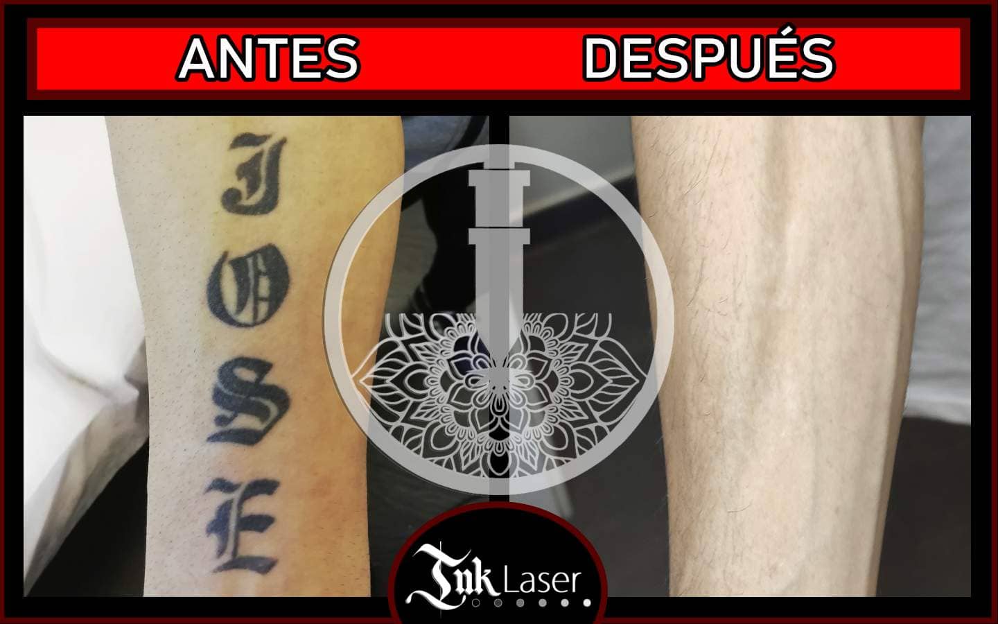 Laser tatuajes Alicante